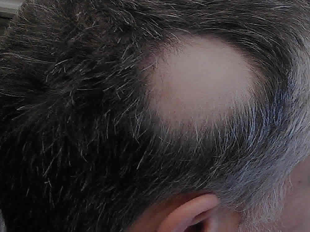 Diagnosis, Advice & Treatment for Alopecia Areata in Bolton