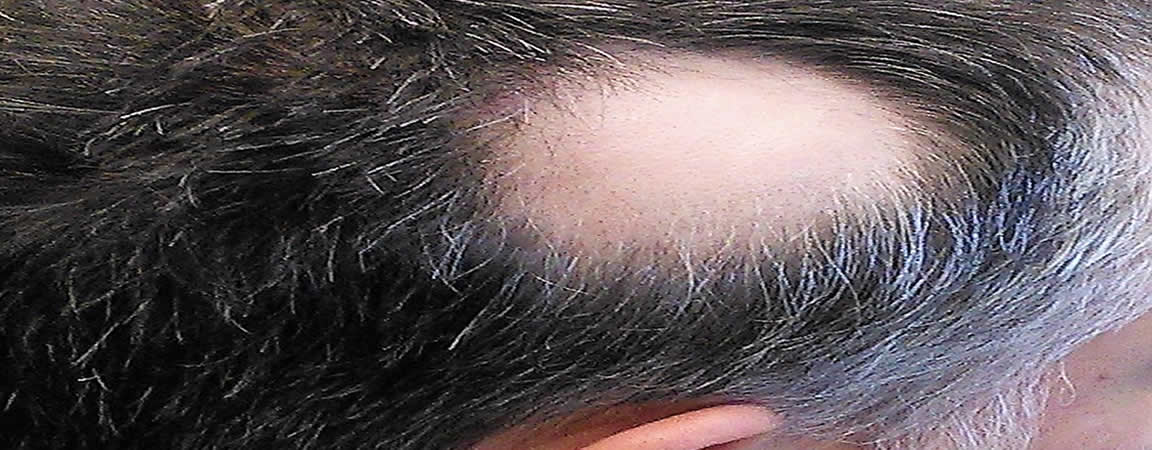 alopecia areata treatment Bolton